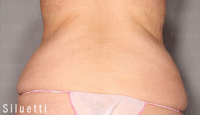 Siluetti - abdominoplastia ennen ja jlkeen