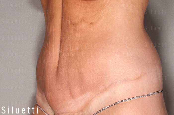 Siluetti - abdominoplastia ennen ja jlkeen